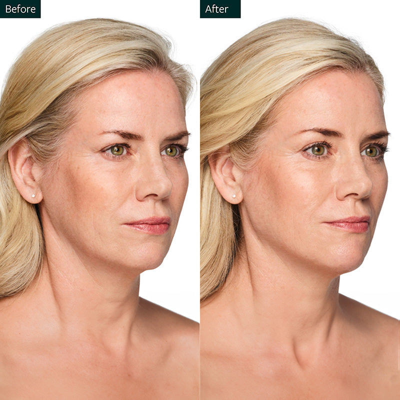 Juvederm Volux® XC